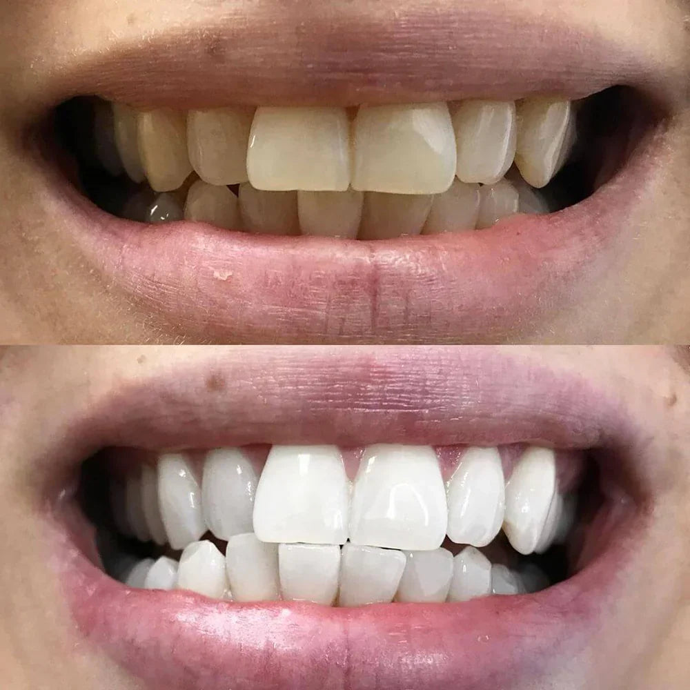 Pióro do wybielania zębów Diamond Smile