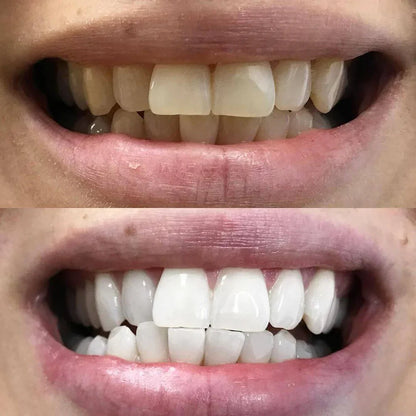 Pióro do wybielania zębów Diamond Smile
