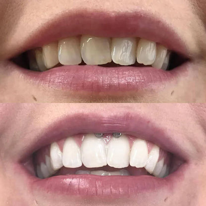 Pióro do wybielania zębów Diamond Smile